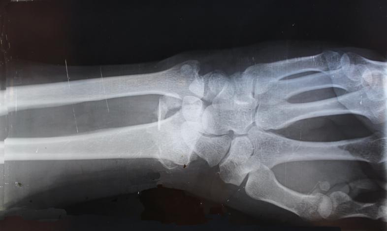 X-ray of a wrist